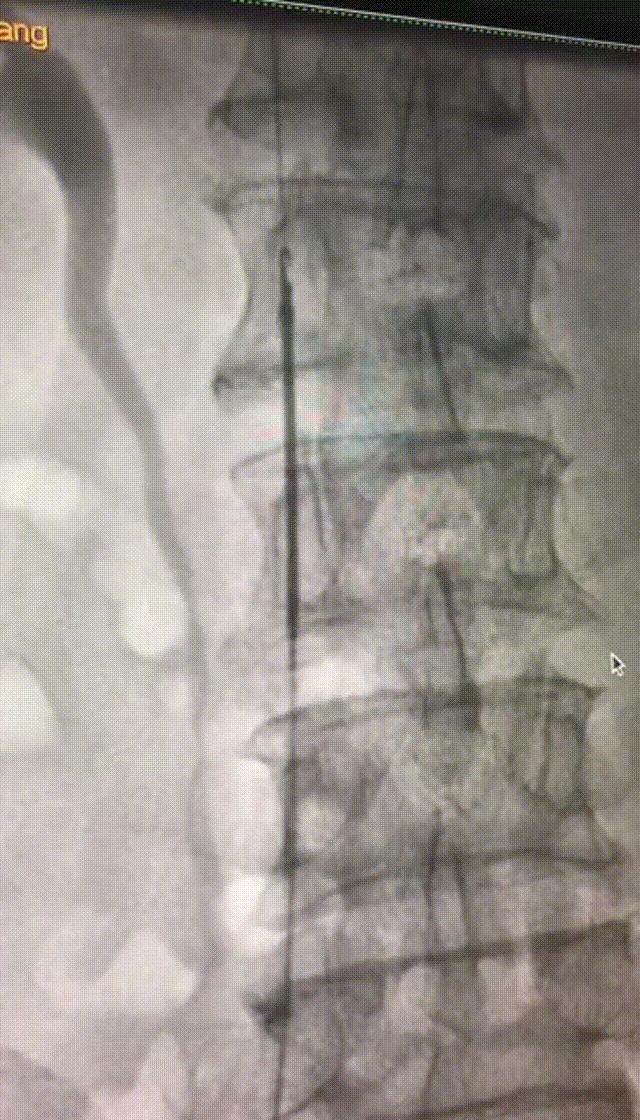 医者仁心|小滤器大作用！撑起生命的保护伞