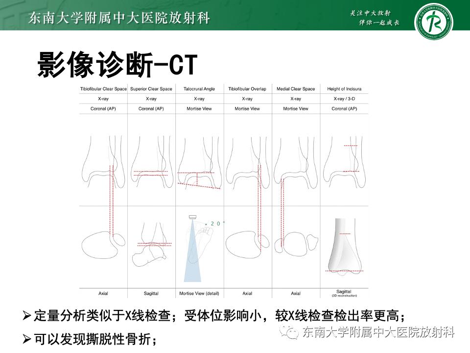 左腓骨下段骨折伴下胫腓联合分离,好文分享深度揭秘