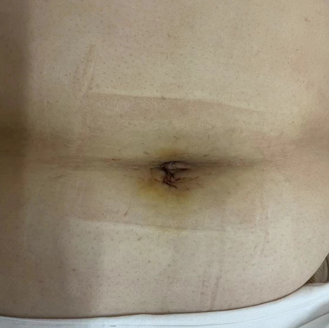 单孔腹腔镜技术让妇科手术不留疤,单孔腹腔镜在妇科手术的优势