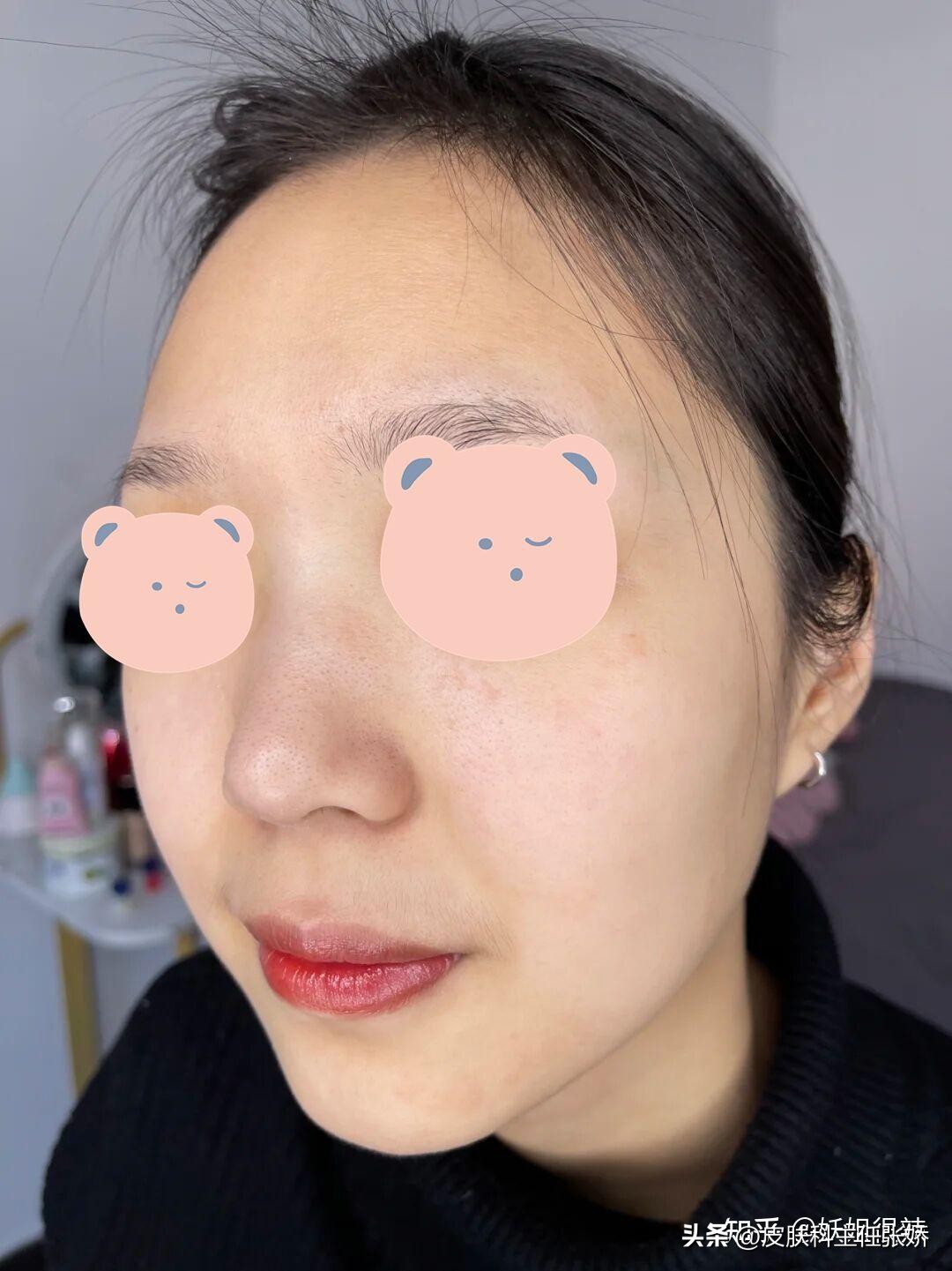 巨大黑头怎么治疗,黑头怎么治疗最有效儿童