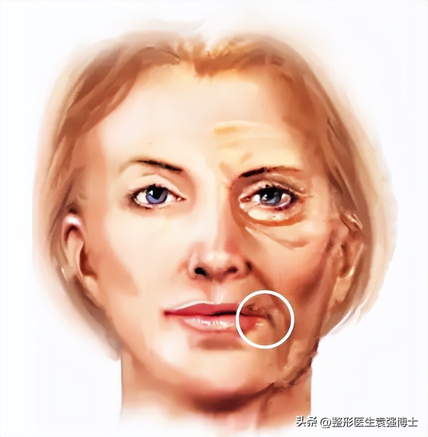 面部皮肤松弛形成口角囊袋,口角囊袋是皮肤松弛的结果吗