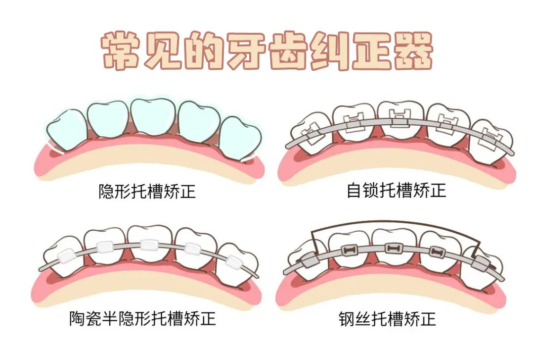 暑期牙齿矫正黄金季,牙齿矫正省钱攻略