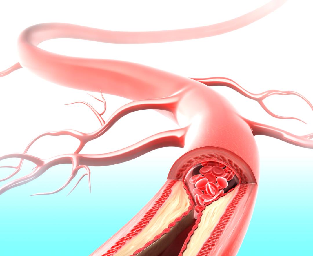 动脉硬化最佳治疗用药,动脉硬化最怕3个动作