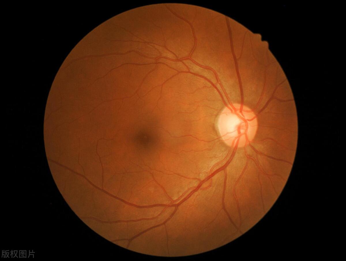 年轻人眼睛模糊怎么恢复,人老了眼睛模糊看不清是怎么回事