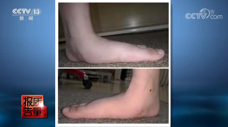 儿童足外翻硬鞋底还是软鞋底好,软鞋底会导致扁平足吗