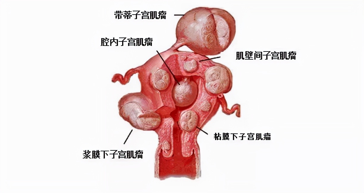 实体瘤多大需要做手术,有个小粉瘤必须做手术吗
