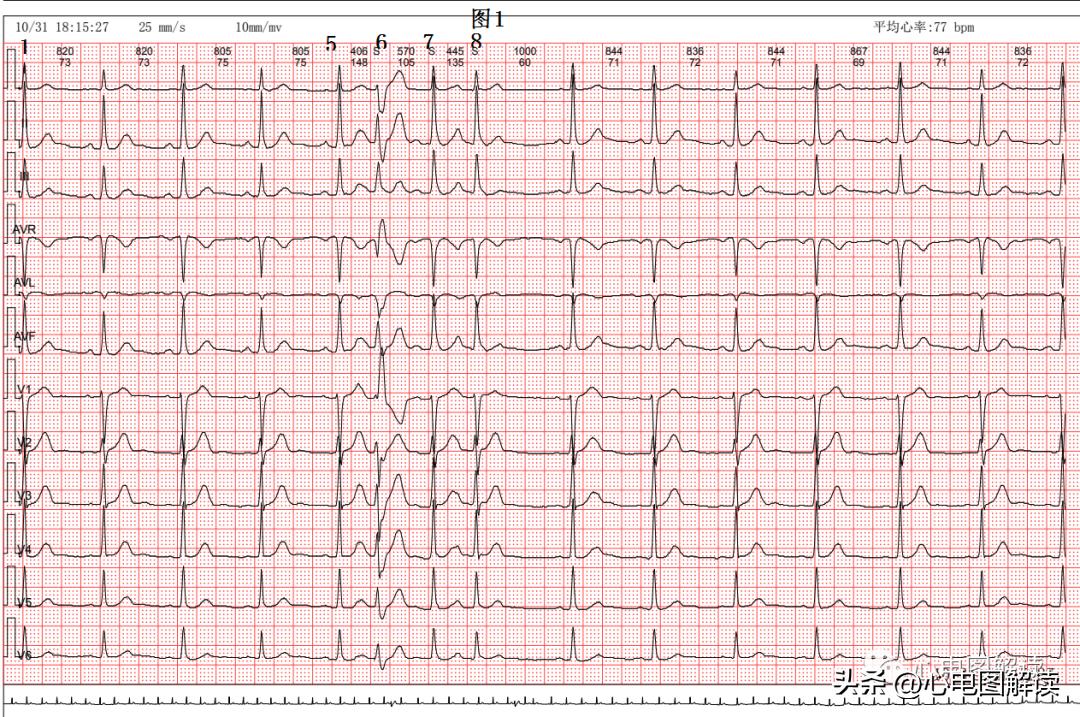房性早搏和房颤会同时存在吗,频发房早会演变成房颤吗