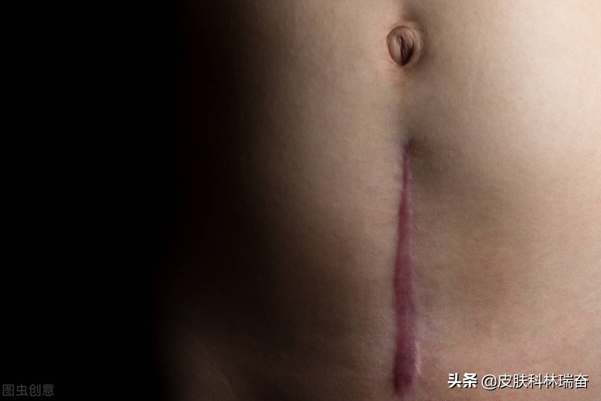 8种消除疤痕的自然方法,处理疤痕最好的方法