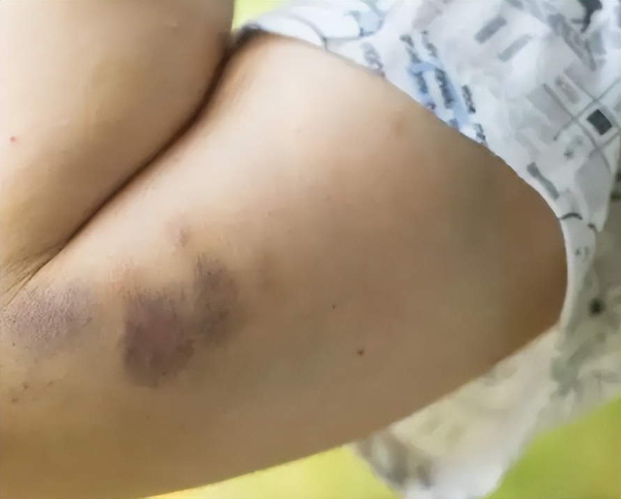 筋膜枪的作用和危害,筋膜枪的三大危害禁忌