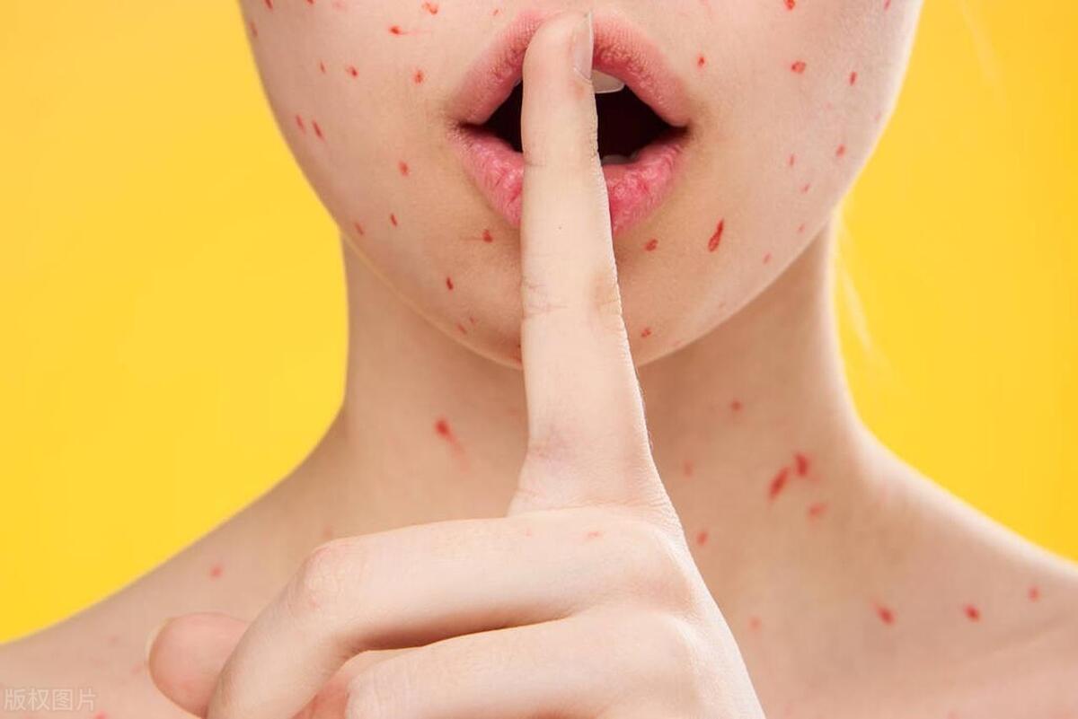 过敏性紫癜是真菌性皮肤病吗,过敏性紫癜是皮肤病还是什么