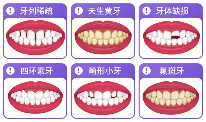 烟渍牙变白最快的方法,牙变白最快最简单