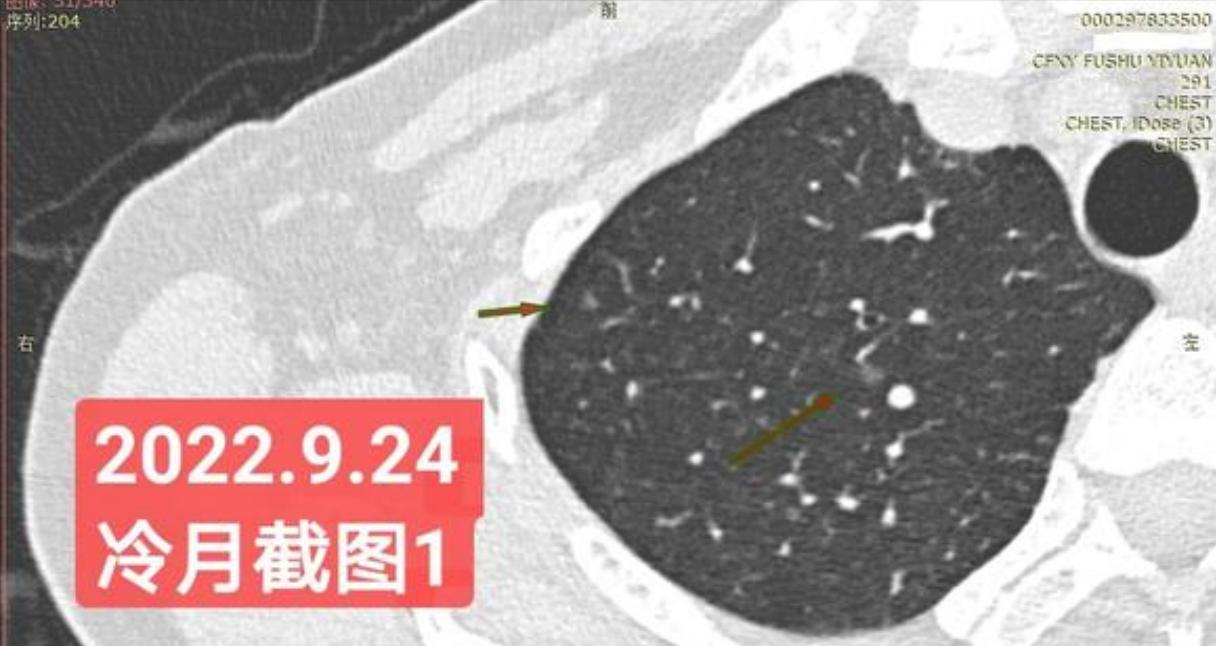 7mm肺结节恶性的怎么办,7mm实性肺结节危险程度