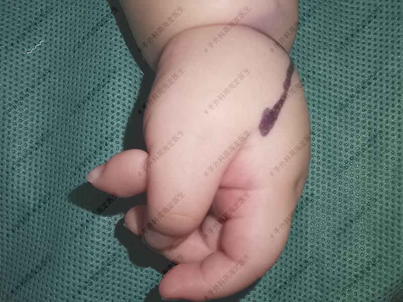 宝宝大拇指伸不直能揉好吗,宝宝大拇指漂浮