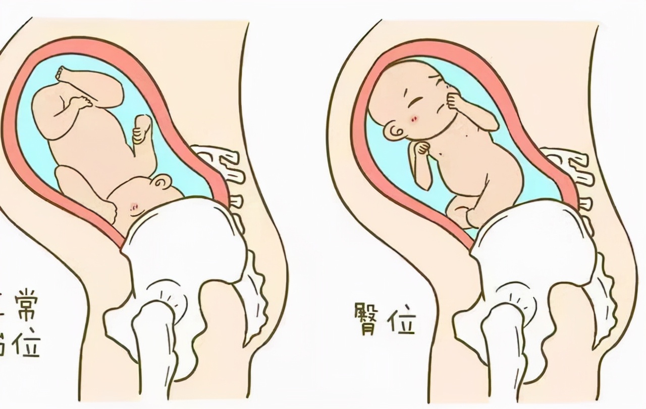 孕妈日记119,36周头位37周变臀位了怎么办