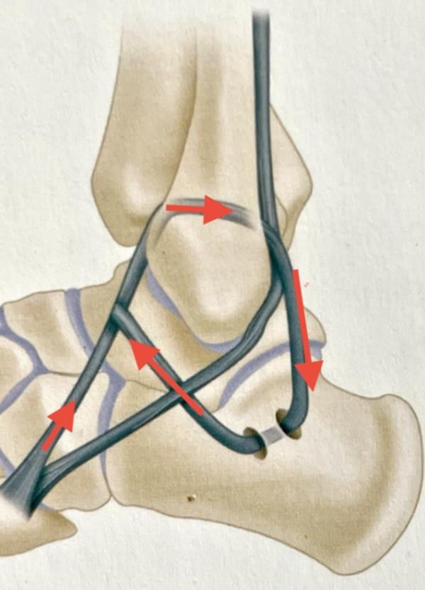 踝关节韧带损伤病历模板,踝关节外侧韧带损伤发病原因