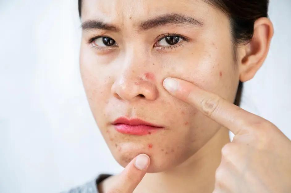 u牌化妆品能祛痘吗,u牌化妆品祛痘怎么样