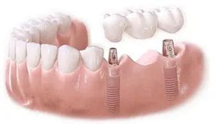 老年人牙齿治疗方案,老年人牙坏了很多怎么修才好