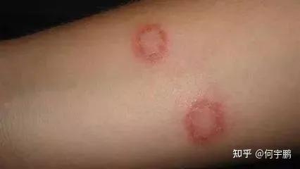 猫癣治疗最快的办法,猫癣怎么治疗最快