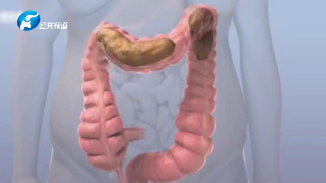 外科手术治便秘,胃肠外科手术便秘