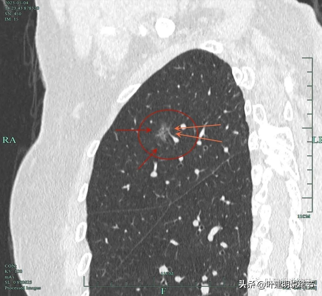 肺楔形切除肺功能降低,肺楔形切除需要缝合吗