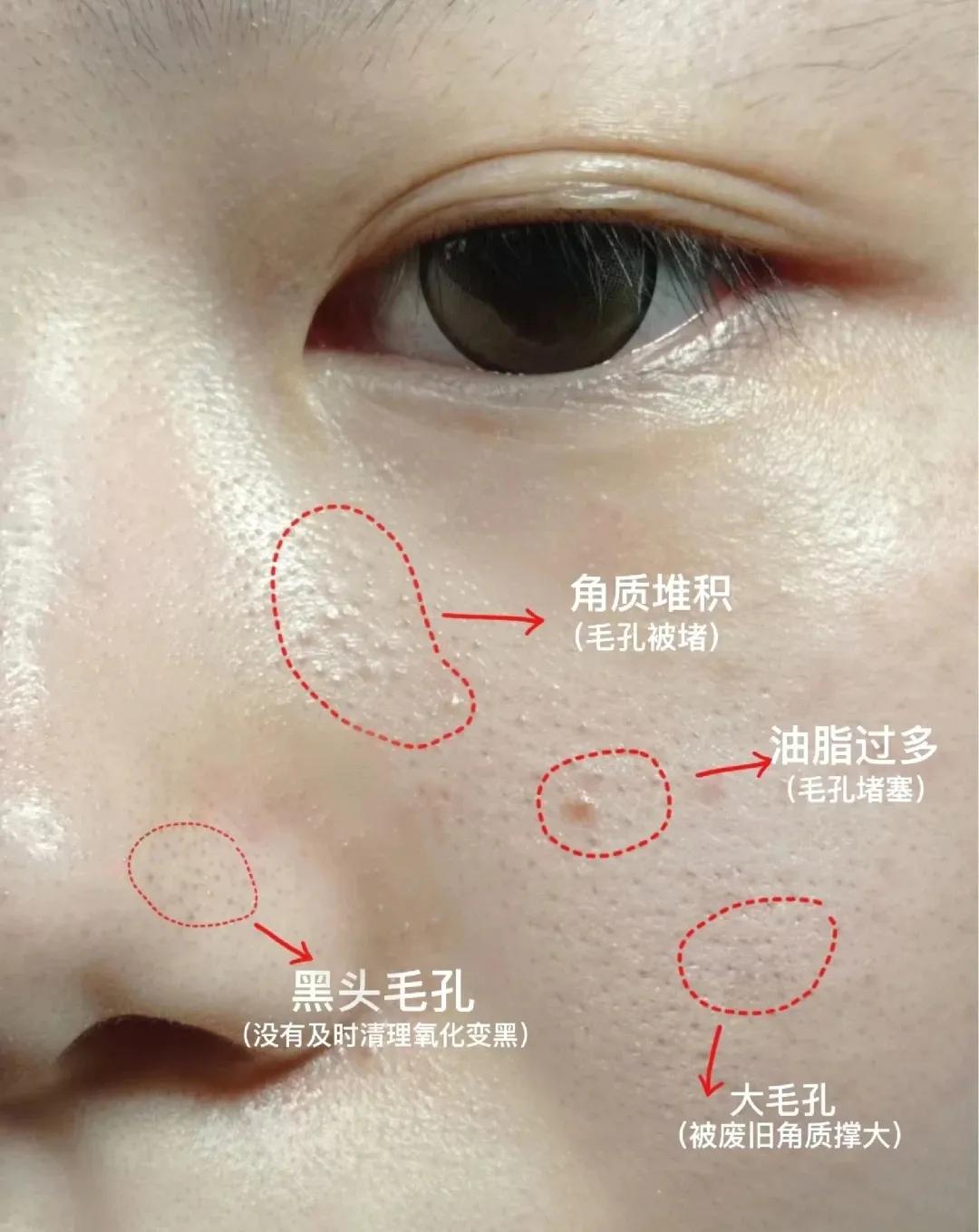 几款解决毛孔粗大的实用方法,毛孔粗大全搞定这些知识要牢记