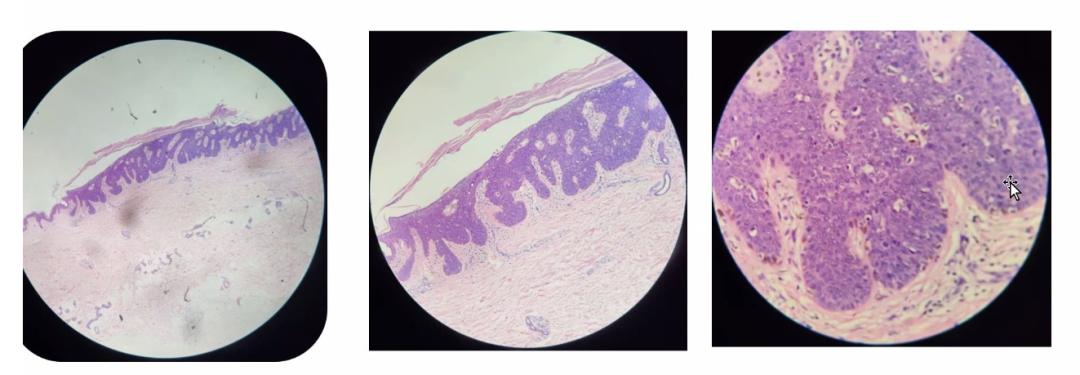 尖锐性湿疣和hpv哪个更严重,尖锐性湿疣是属于hpv高危还是低危