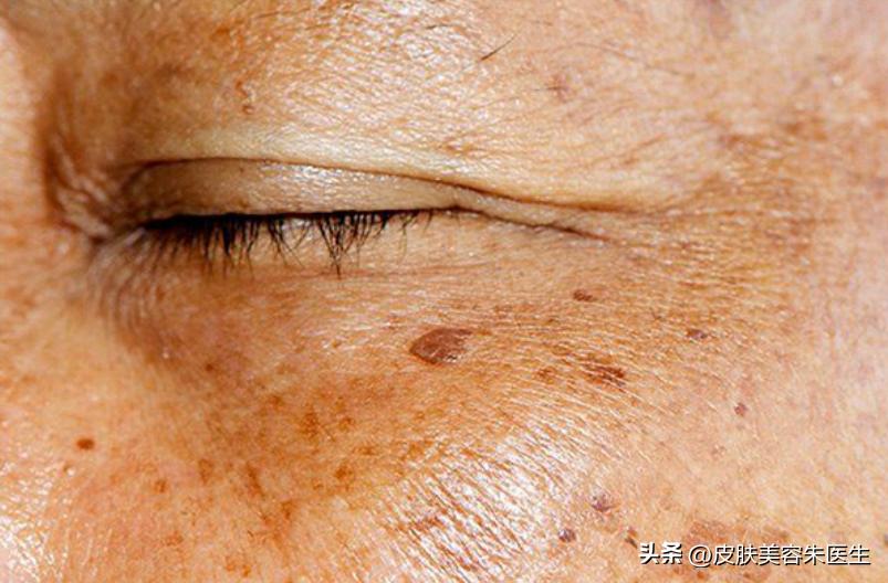 长凸出来的老年斑会是得了癌症吗,40岁老年斑增多是癌症的征兆