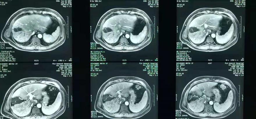 放疗肝内胆管细胞癌能治好吗,放疗治疗肝门静脉癌栓