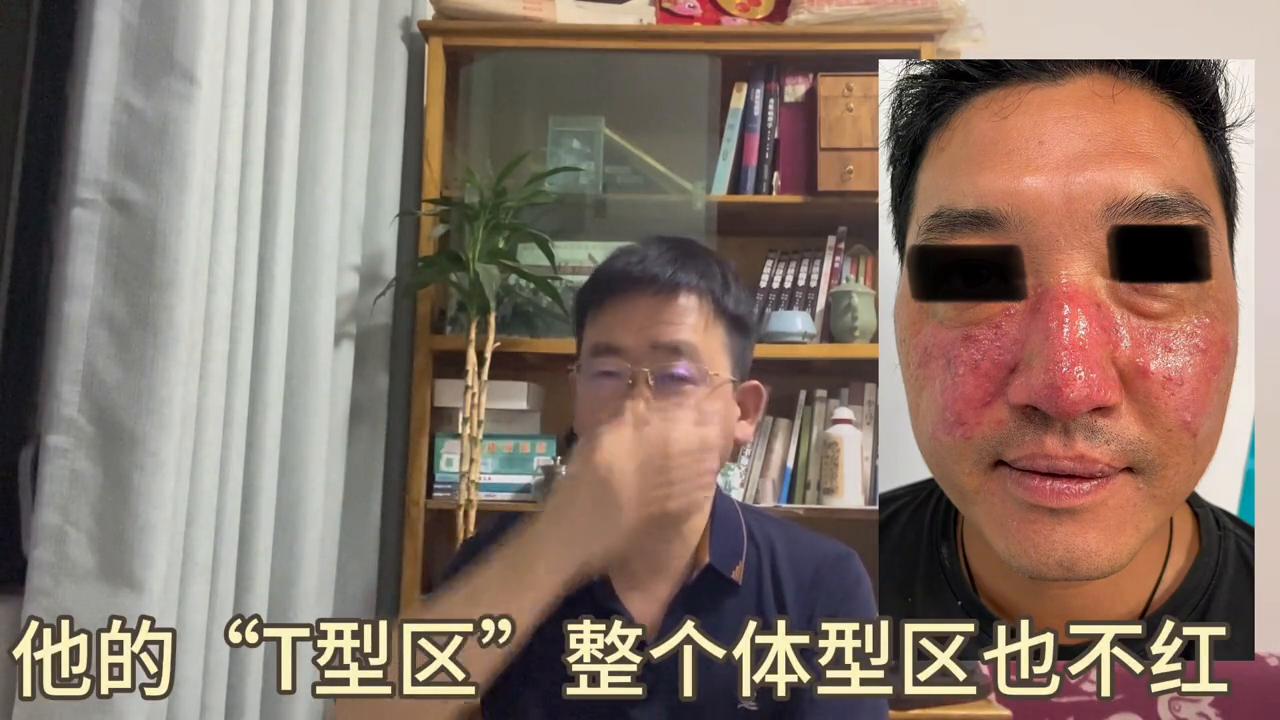 民间治愈玫瑰痤疮的偏方,治玫瑰痤疮的特效药