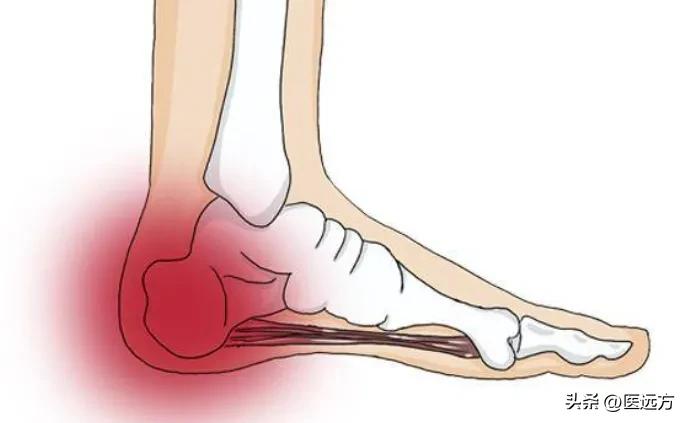 风湿瘀虚，脚跟疼痛？送你4个中成药，化解风湿瘀虚，快收藏