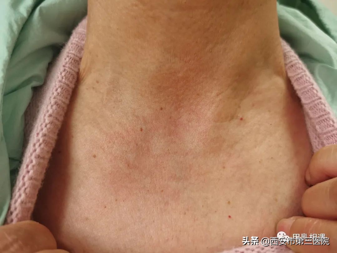 做甲状腺手术后瘢痕怎么描述,疤痕体质甲状腺手术后疤痕怎么办