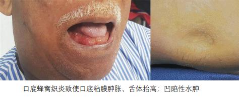 一颗智齿要了命,一颗智齿发炎