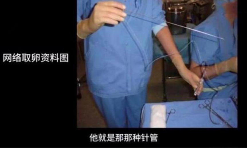 卖卵*市黑**盯准高颜值高学历女大学生，不麻醉，长针直接穿刺