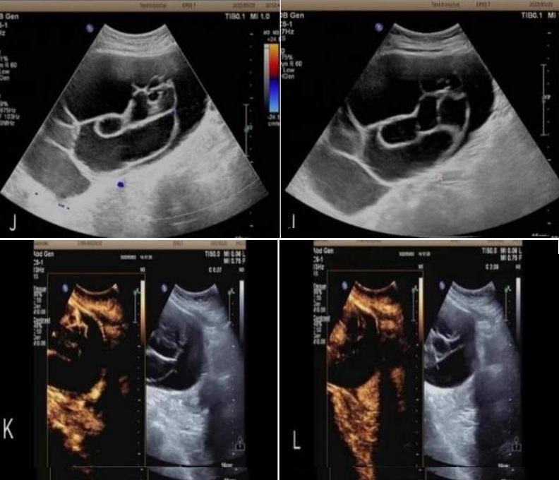 超声静脉造影剂注射操作视频,超声静脉自显影