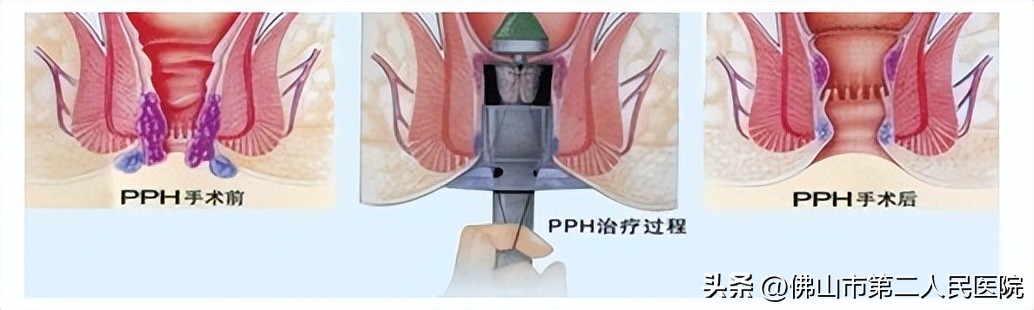 春节放肆嗨，节后便秘肛裂出血，难道是……