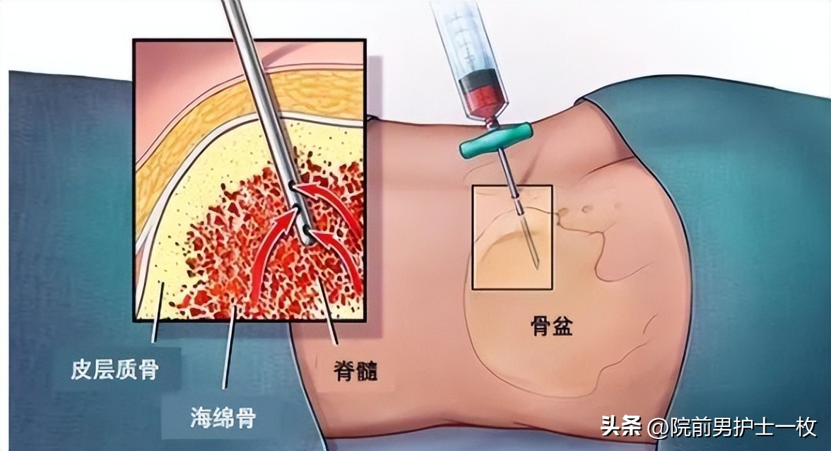 背部骨髓穿刺术,技术移植法