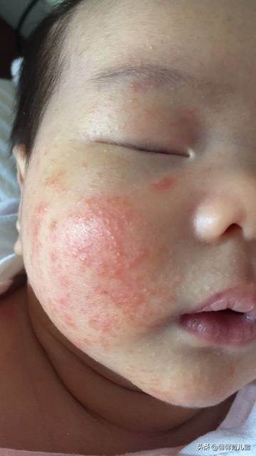 宝宝湿疹护肤经验分享,宝宝湿疹的最好治愈方法