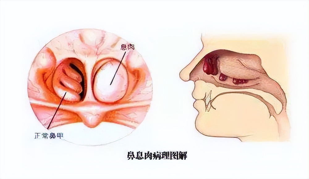 鼻息肉手术后要预防什么,怎样预防鼻窦炎和鼻息肉