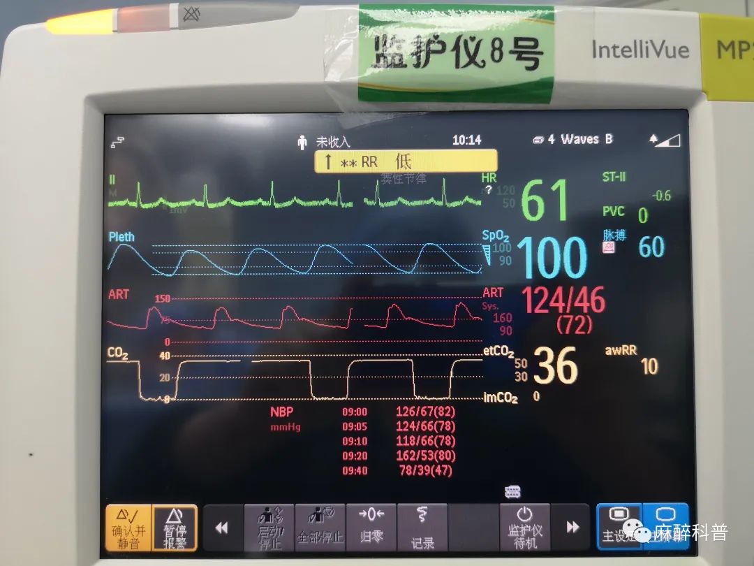麻醉医生遇见三度房室传导阻滞怎么办？教你一招破解之术
