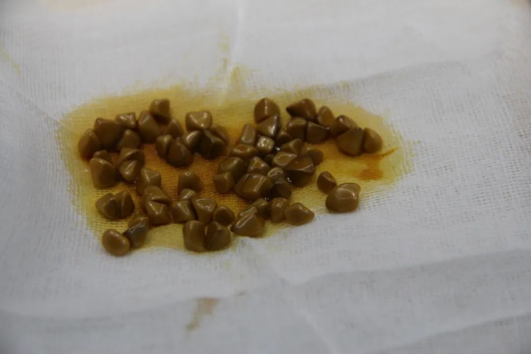 胆结石很小的时候医生说不用处理,胆结石不痛的情况下需不需要治疗