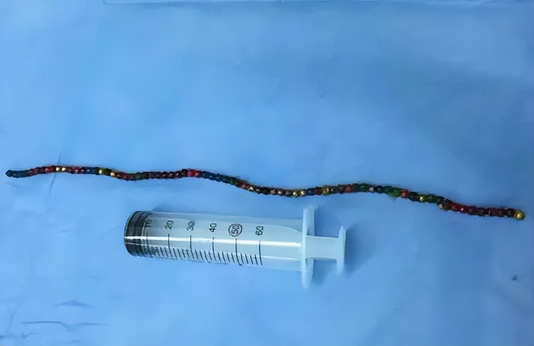 11个月大婴儿,吞下一枚3cm钉子!家长平时一定要收好家中小物品