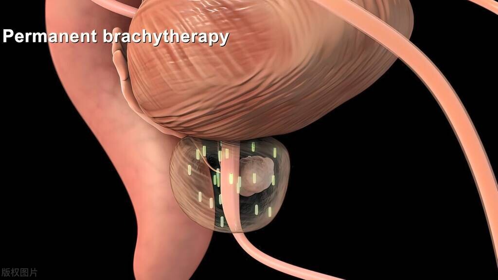 中年患上“前列腺”该如何治疗？听听专业医生的分析