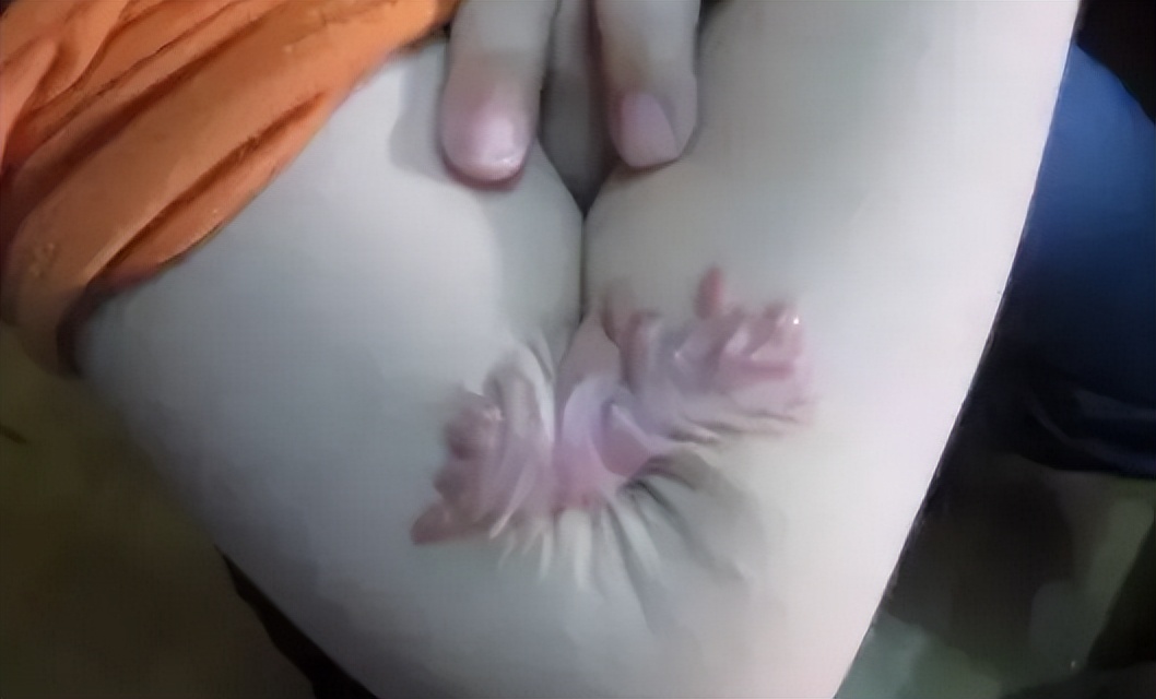 烧烫伤疤痕如何修复？烧烫伤疤痕怎么治疗？