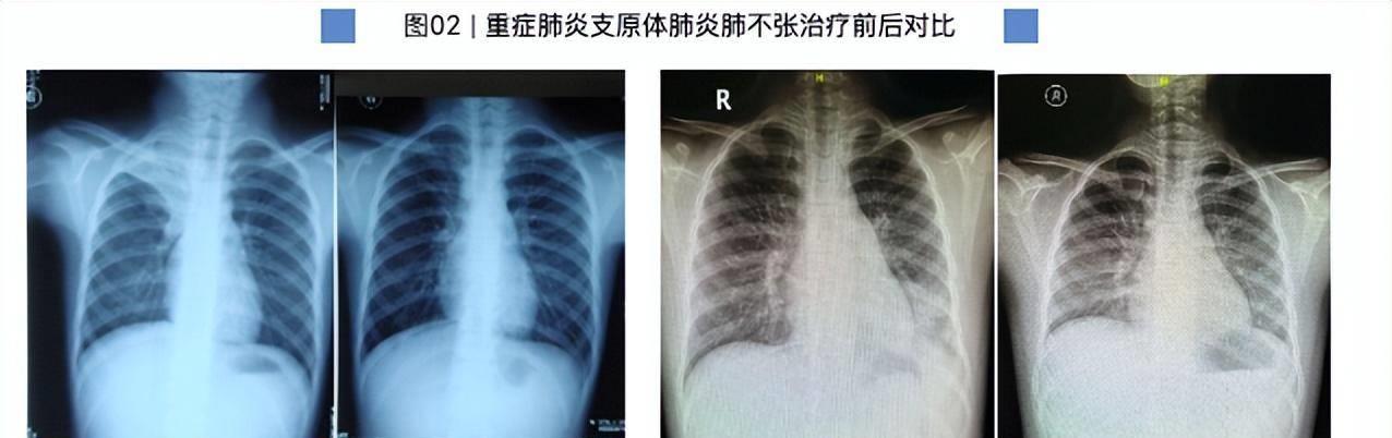 7岁男童肺部发生实变必须洗肺吗,七岁男童肺实变