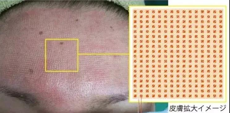 痘印开始变成痘坑了怎么办,痘印痘坑怎么修复最好的办法