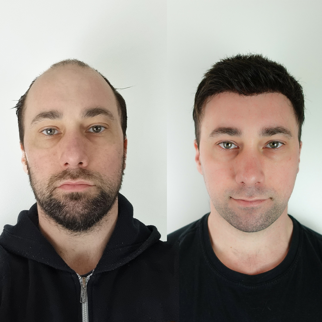 怎么解决在英国脱发,英国秃头率