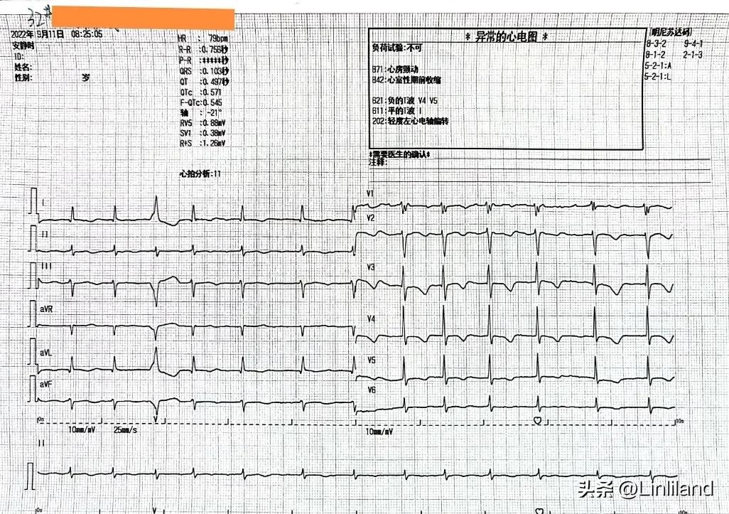 过速性房颤治疗,持续性房颤心动过速