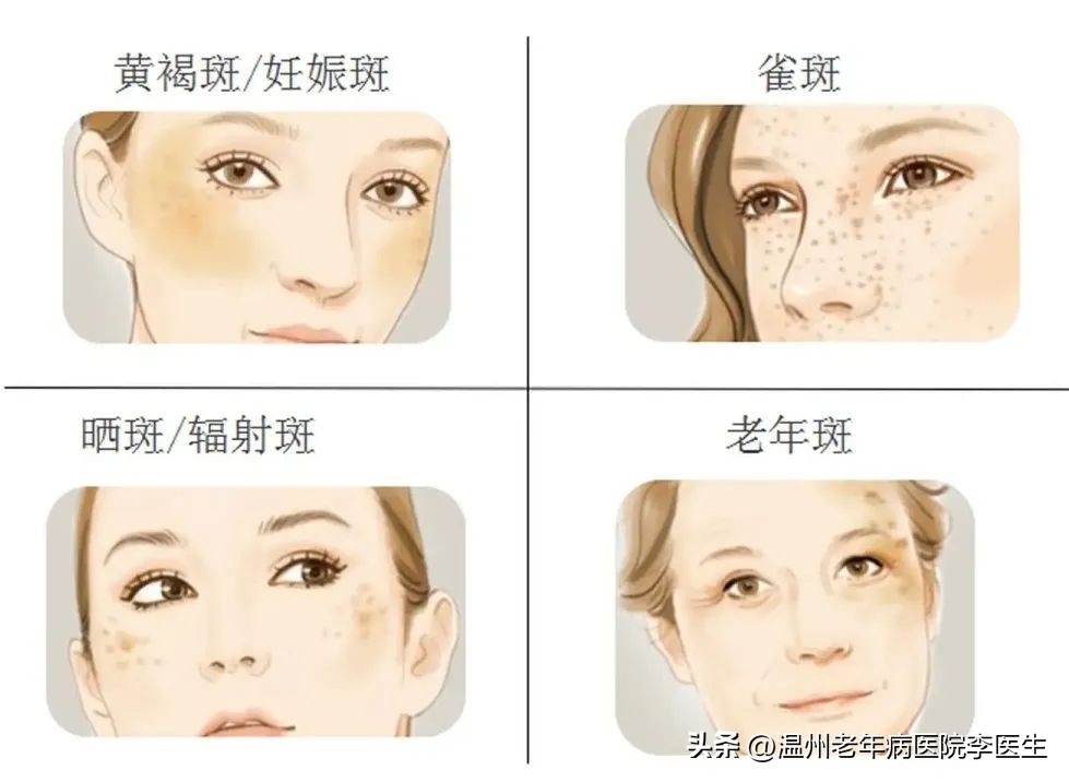 淡斑超光子,美白嫩肤光子