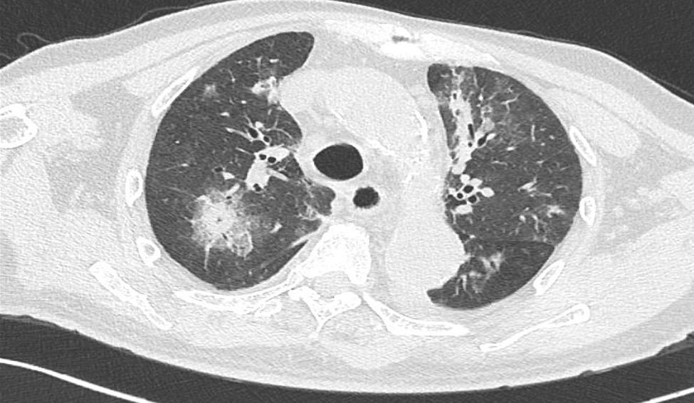 老人新冠后肺部感染严重多久恢复,新冠肺炎症状好转但病灶无明显吸收