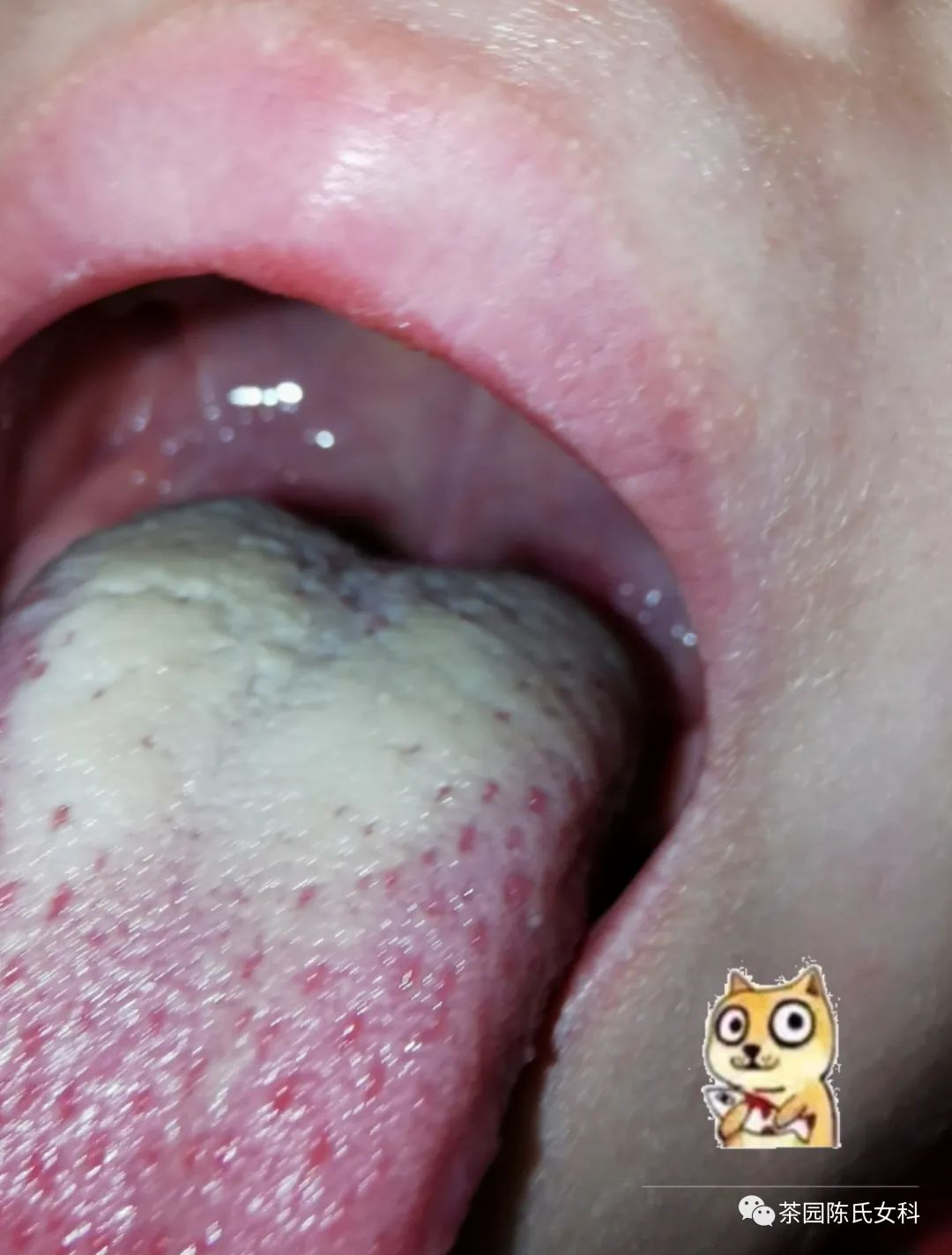 小儿积食的病因,小孩会出现食积吗